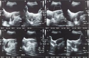 Miomas Uterinos